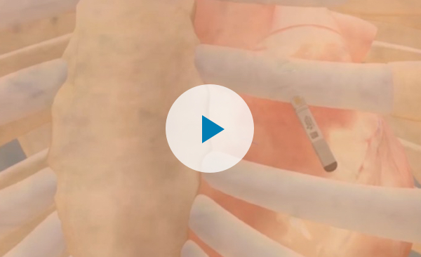 : Illustration of human ribcage with button to play the insertion procedure animation